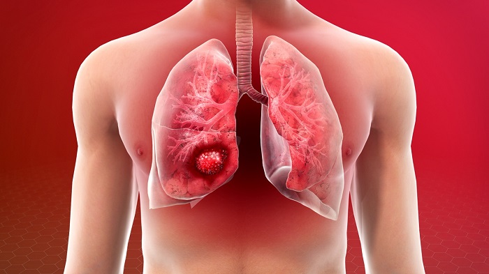 What are the side effects of lung suction?