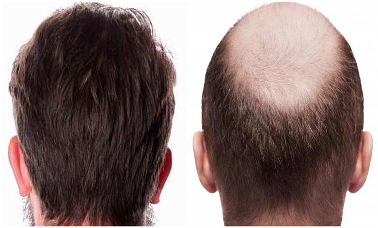 Hair transplantation for the low back of the head